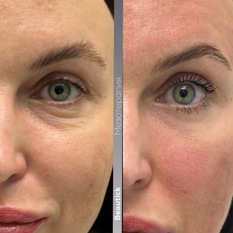 Мезотерапия