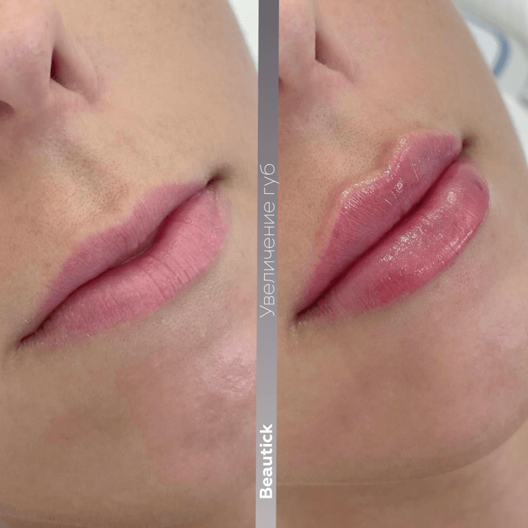 Контурная пластика губ