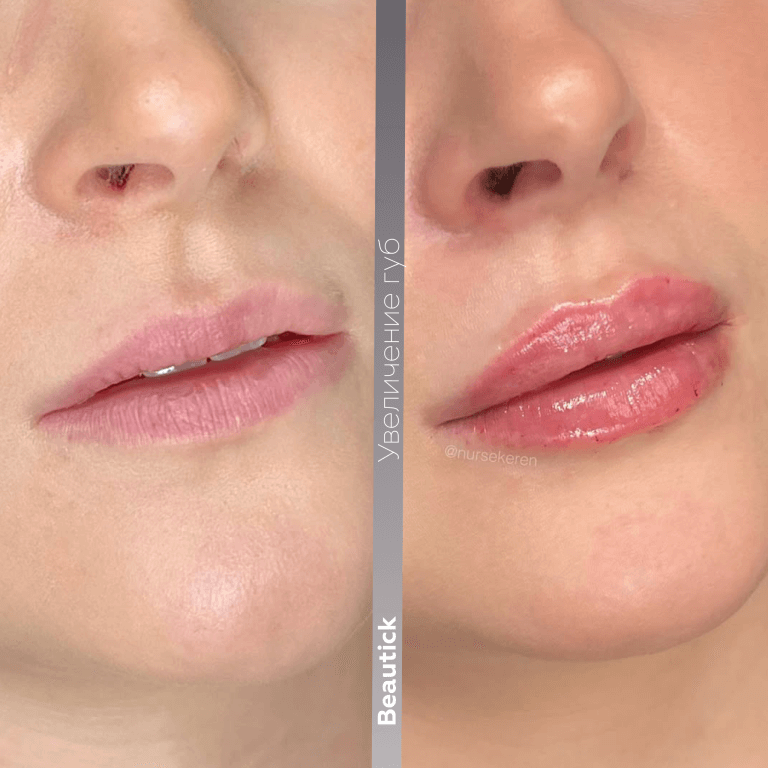 Контурная пластика губ