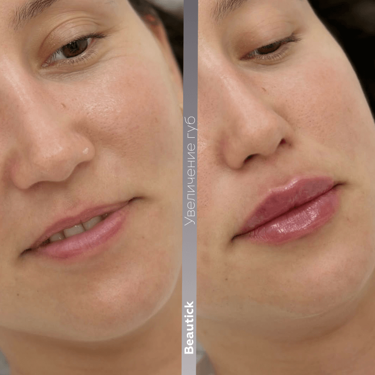 Контурная пластика губ
