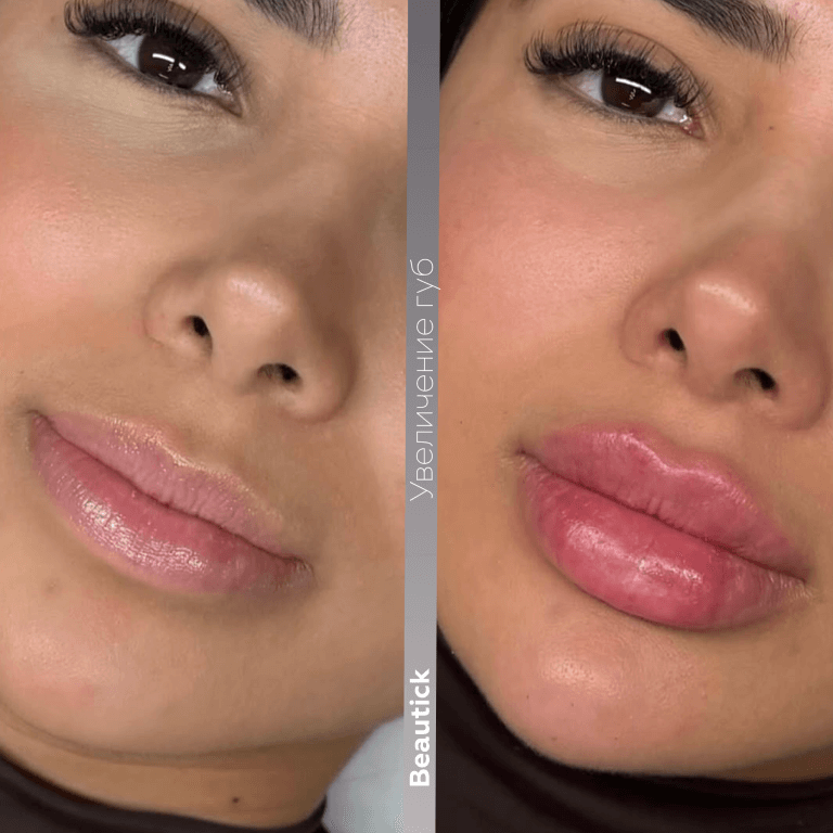 Контурная пластика губ