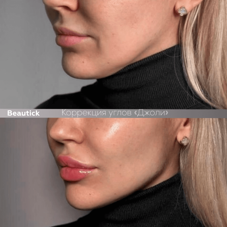 Углы Джоли