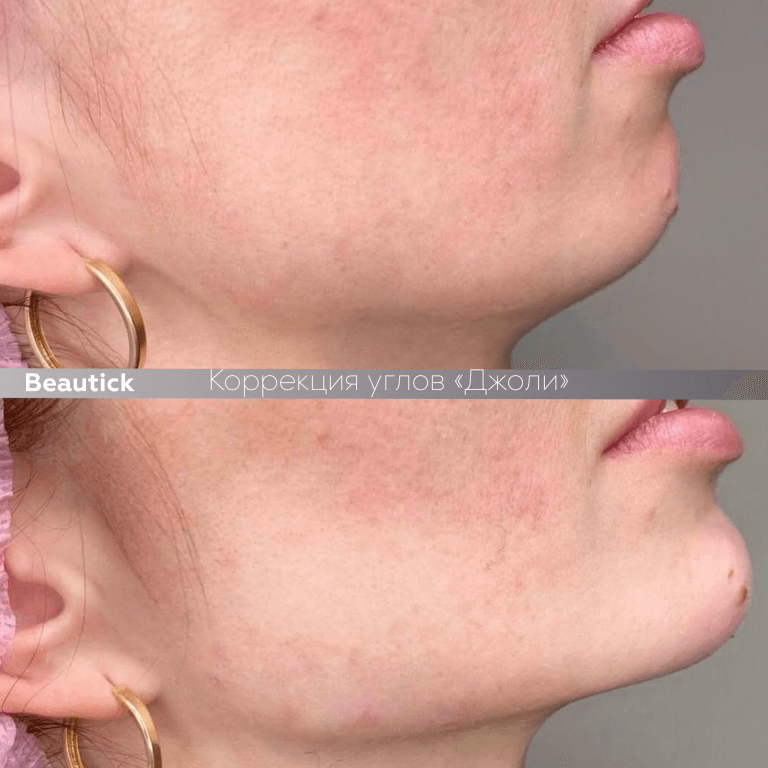 Углы Джоли