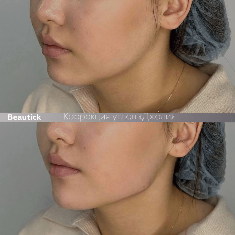 Углы Джоли