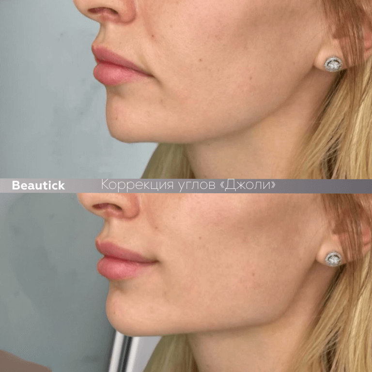 Углы Джоли